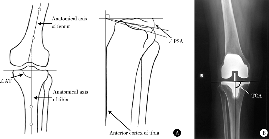 胫骨侧徒手截骨的膝关节置换术后力线测量及其影响