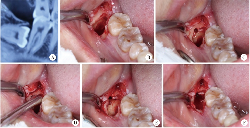下颌阻生智齿拔除手术的可预期微创化