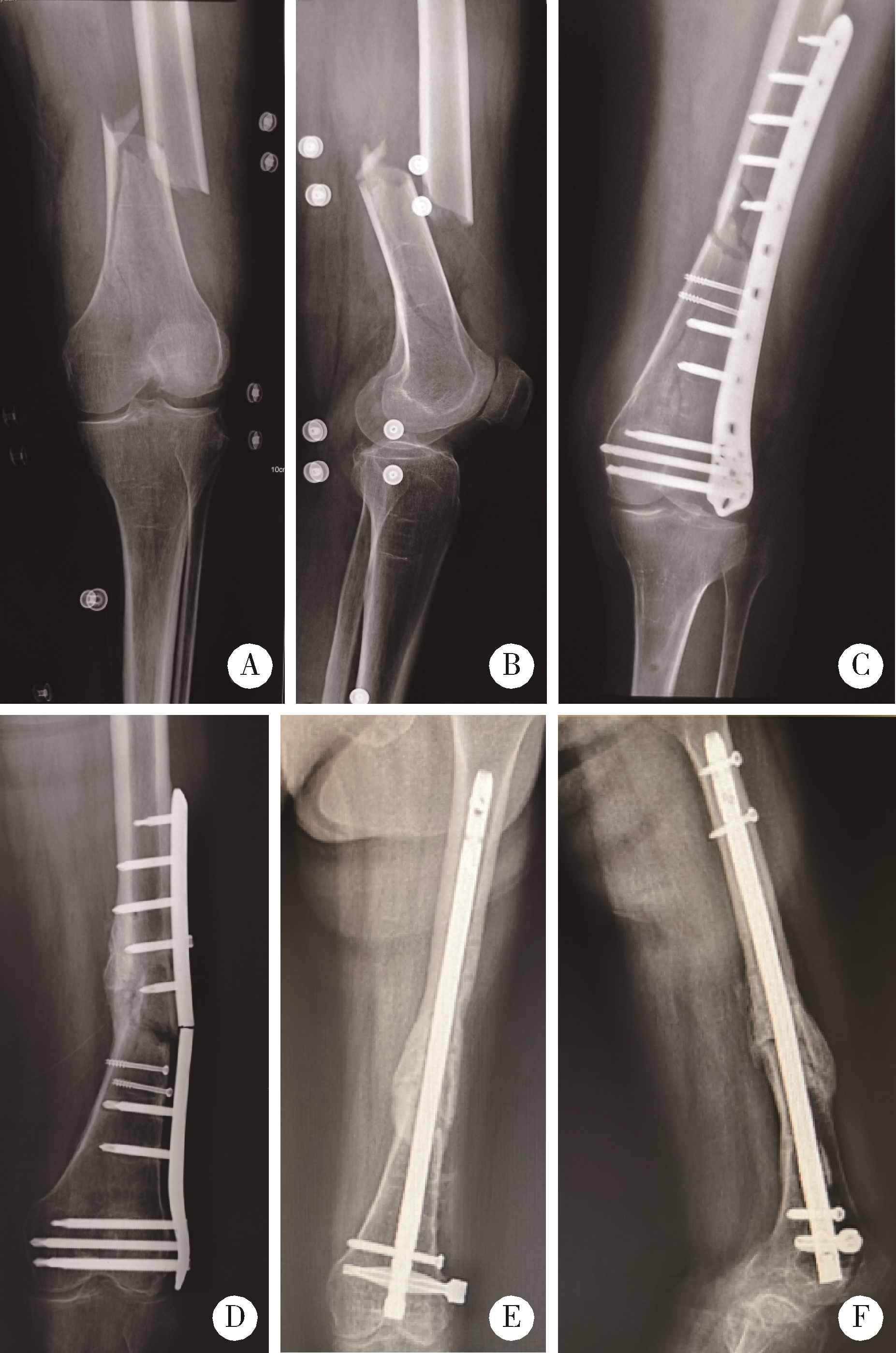 外侧锁定接骨板治疗股骨远端骨折术后翻修的相关影响因素