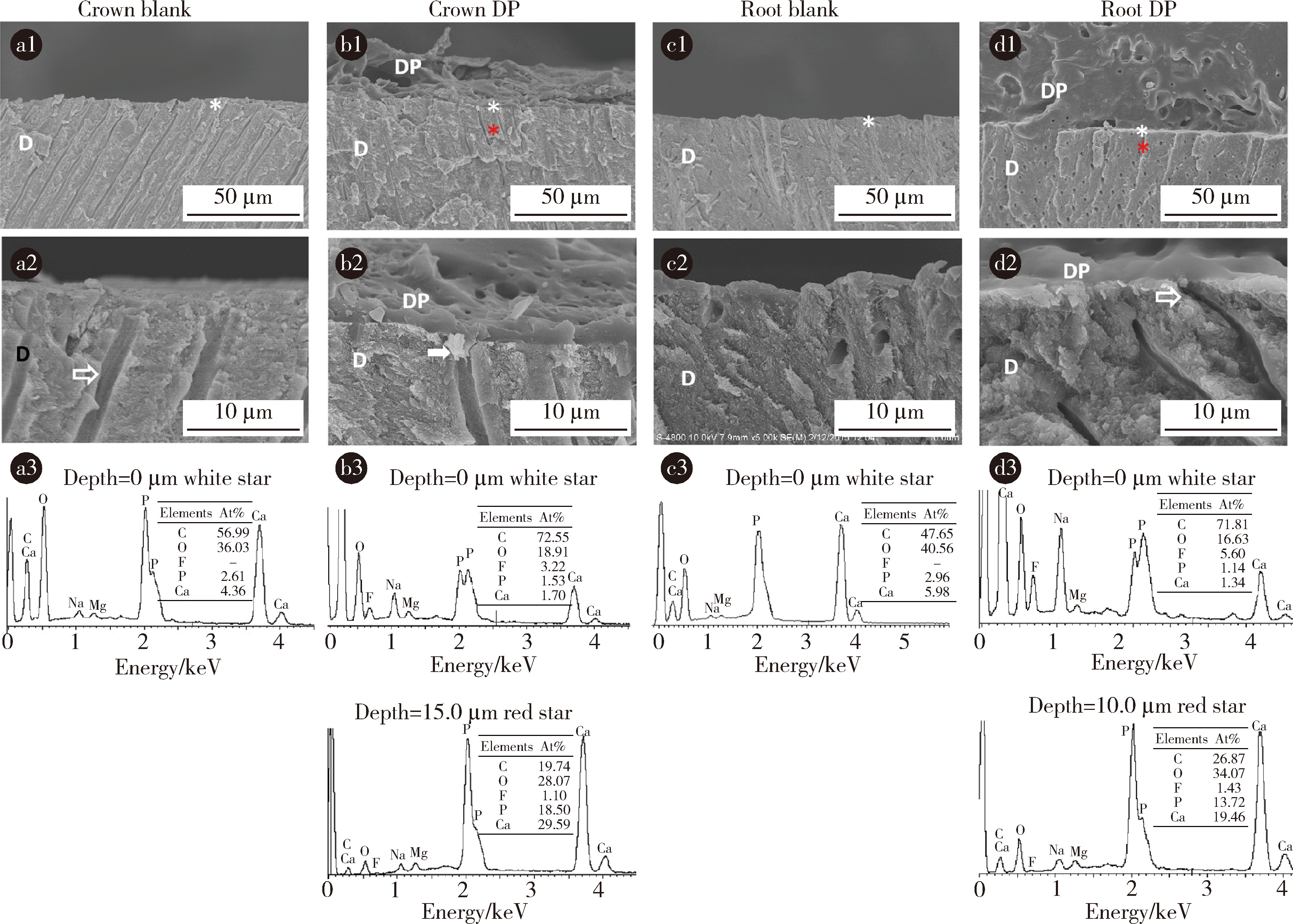 Durability Of The Anti Demineralization Effects Of Fluoride Varnish On